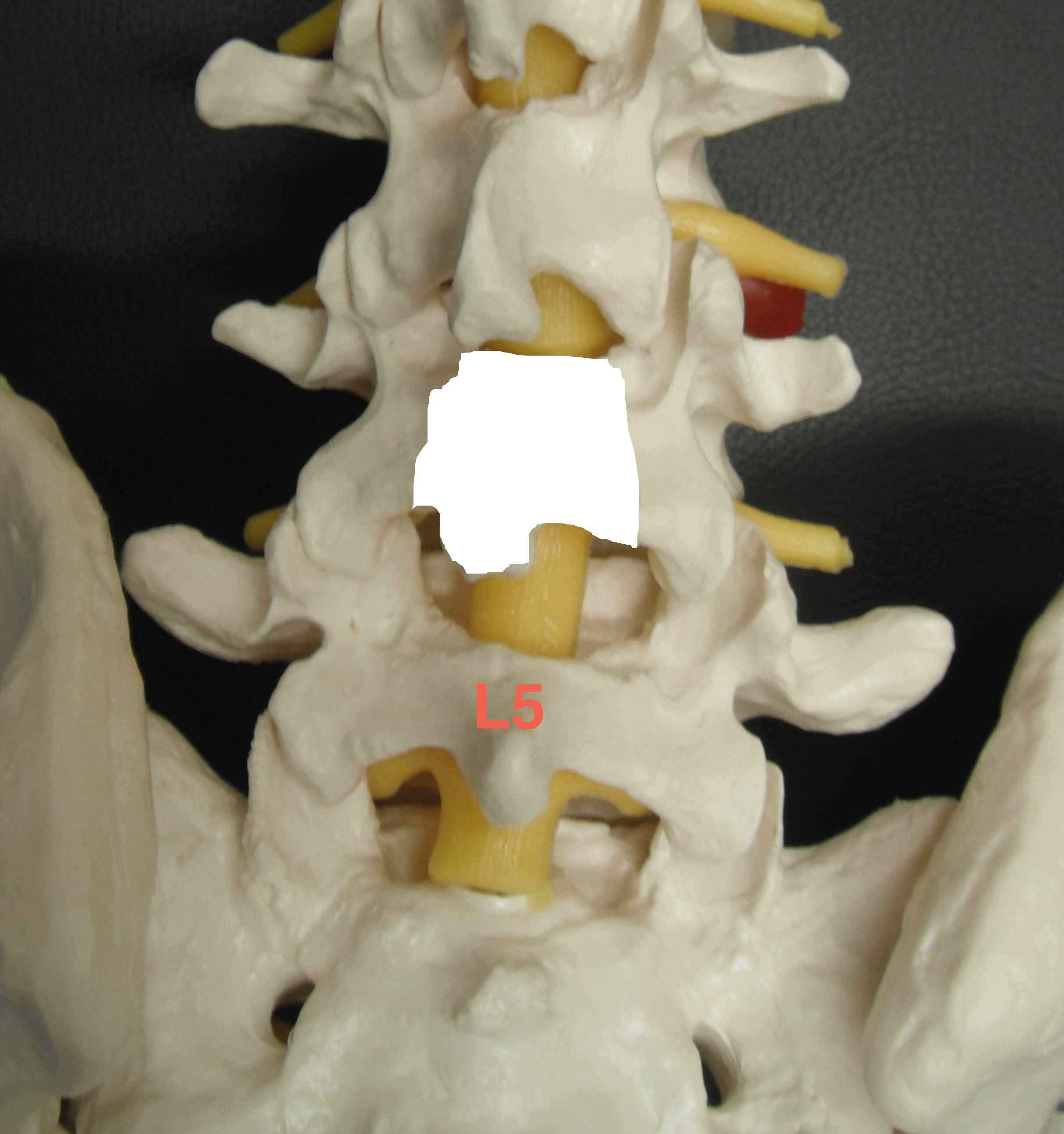 L4 5 Decompression Laminectomy